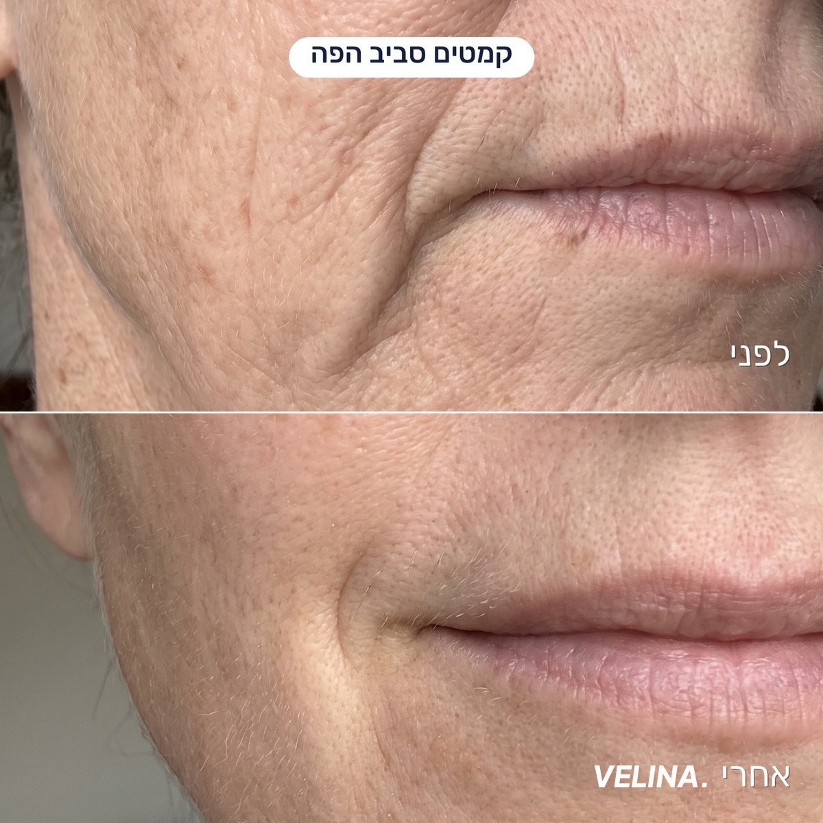 לפני ואחרי - קמטים סביב הפה