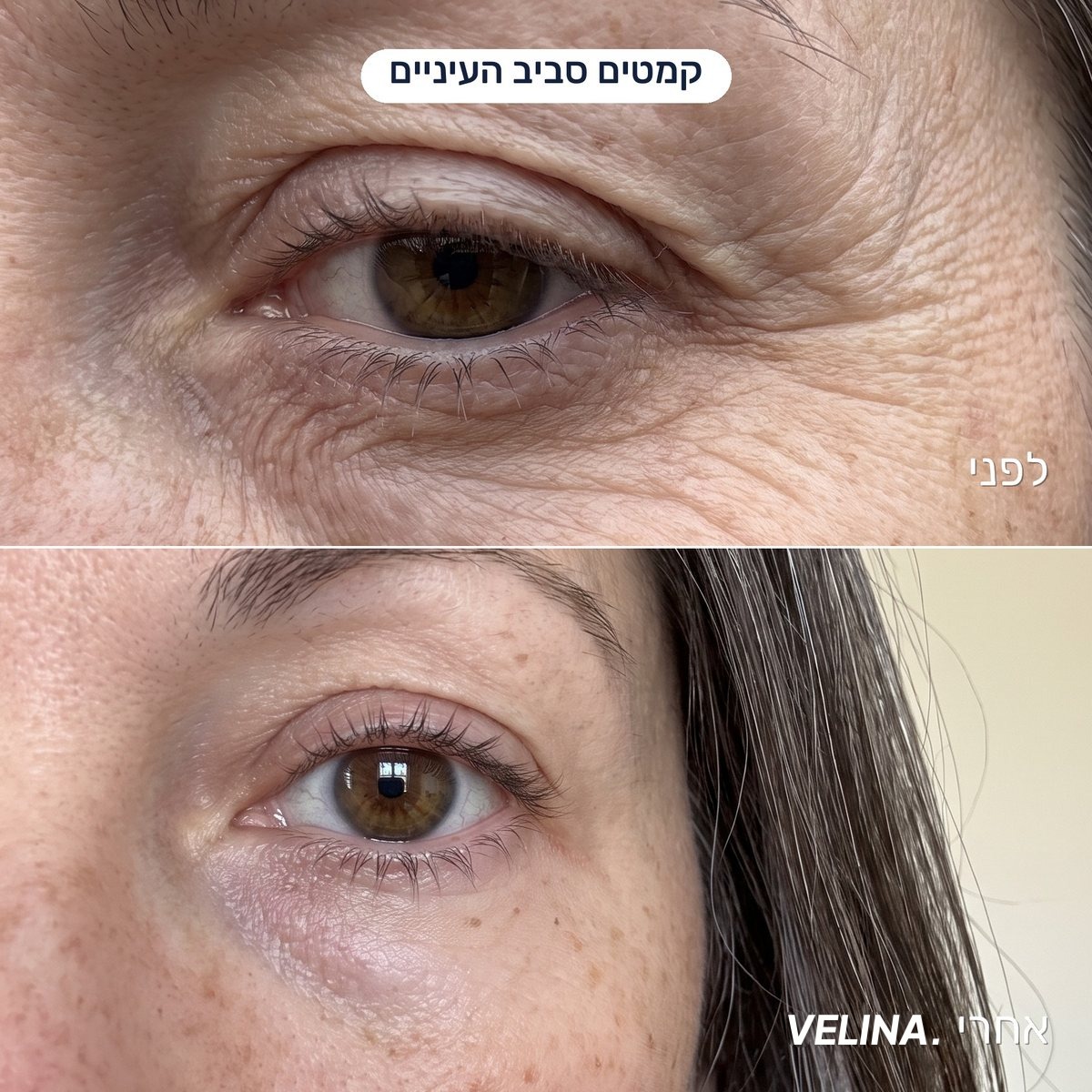 לפני ואחרי - קמטים סביב העיניים